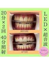 ココティ ホワイトニング(Cocotii)/ビフォーアフター