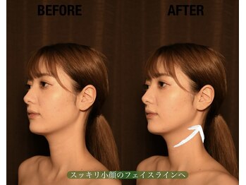 ブライダルエステ バイ スイスパ表参道(BRIDAL ESTHE by SUI SPA)/【小顔矯正】小顔 Before→After
