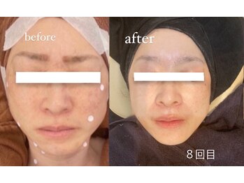 イル 名取店(iru)/光フェイシャル