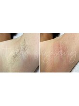 ヒロット タオ(HILOT TAO)/Sugaring ワキ脱毛