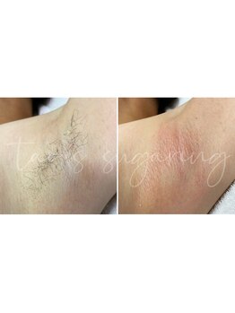 ヒロット タオ(HILOT TAO)/Sugaring ワキ脱毛