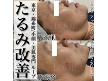 ループ(LOOP)の雰囲気（最新リフトアップマシンで脂肪やたるみケア！）