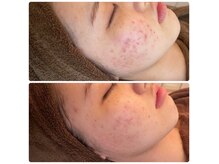 サロンリエム(Salon Riem.)の雰囲気（厳選国産ハーブで剥離ダウンタイムなし！毛穴ケア、ニキビケア◎）