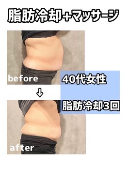 メゾンドロイヤル(Maison_de_ROYAL)/脂肪冷却!