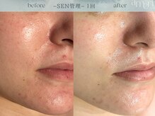 スキンラボアメリ(skin lab. ameri)/お悩み…赤みニキビゆらぎ肌