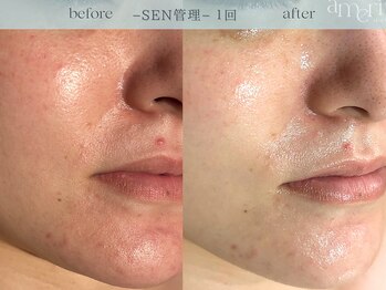 スキンラボアメリ(skin lab. ameri)/お悩み…赤みニキビゆらぎ肌