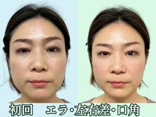 ナチュラルパーフェクトフェイス 新宿/初回/ビフォーアフター/新宿小顔