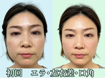 ナチュラルパーフェクトフェイス 新宿/初回/ビフォーアフター/新宿小顔