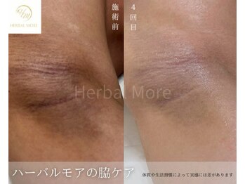 スキニティ 池袋(sknity)/<脇>ハーブの力でなめらかな質感