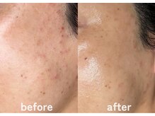 ホワイトアクア 鹿児島店(WHITE AQUA)/ララピール/鹿児島/ニキビケア