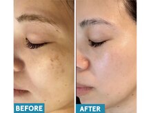 シミのお悩みはお任せ下さい♪