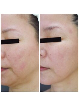 ダリア(DALIA)/エンダモリフトでフェイスリフト