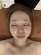 スキニティ(Skinity)の写真/即日陶器のようなハリツヤ透明感へ。毛穴レス肌を叶える本格肌質改善ピーリング