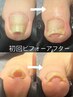 【巻き爪無料相談】 電話予約のみ!!爪トラブルお悩み解決