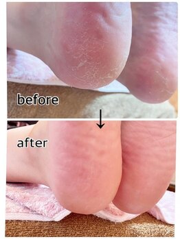 足楽ほんぽ/角質ケア