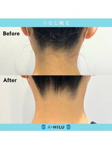 アーヒル(A”-HILU)/うなじ脱毛