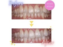 エクシアホワイトニング 静岡駅前店/ビフォーアフター