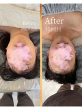 タワワ(TaWaWa)/20代女性　小顔矯正10回目