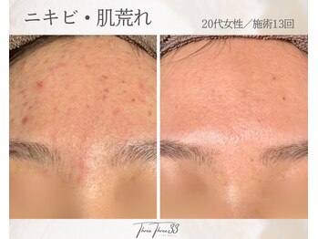 スリースリー(THREE THREE)/ニキビ・肌荒れ