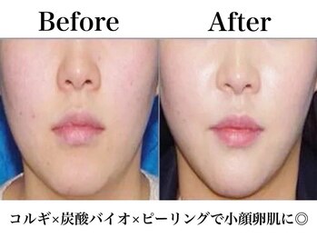 ライゼ(REISE)/定期的な角質ケアで肌質改善!