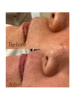 サーラ(SA-RA)/ヒゲ脱毛