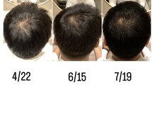 オレオール(aureole)/育毛促進