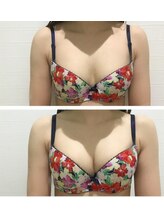 サロンドコーデ(salon de co-de)/バストアップ症例☆