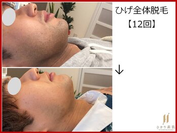 ひかり素肌/ひげ脱毛12回