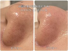 ソワン ド ブランシュ ライフ八戸ノ里店(Soin de Blanche)/小鼻の毛穴洗浄