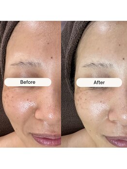 ビーンズ(BEANS)/LALAピール1回でこの違い