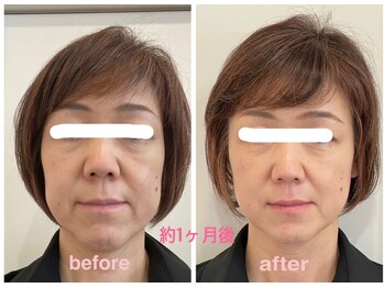 ラウレア 松山店(LAULEA)/インナーケア　before/after