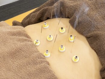 スタイル鍼灸整骨院/お灸