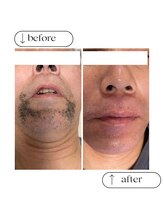 フルールスレーヌ(Fleur Sereine)/清潔感が一番☆本気の髭脱毛