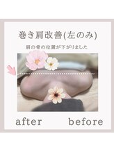 ビューティフィール アンド アリサナ(Beauty Feel&Arisana)/アリサナ症例写真　巻き肩調整
