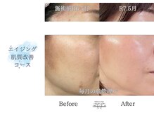 ディアスマイル(Dear.smile)/エイジング肌質改善コース