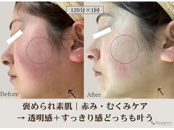 レガロビューティクリエイションズ桜川店/褒められ素肌│赤みケア