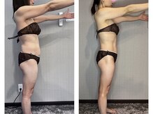 ブリス(bliss)/ウィンバック痩身6回の効果！