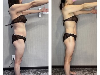 ブリス(bliss)/ウィンバック痩身6回の効果！