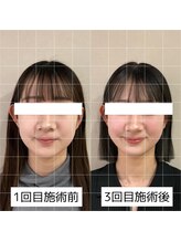 ヴィーライン 大阪梅田院(VeLine)/鍼灸／美容鍼／小顔／大阪／梅田