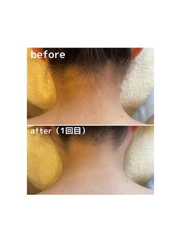 ココロ(KoKoRo)/大人気のデザイン襟足脱毛