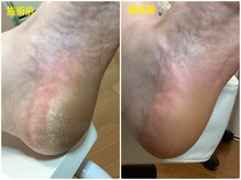 フットケアリストシュウ(footcarelist shu)/施術　ツルツルピカピカ角質ケア