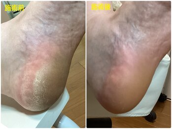 フットケアリストシュウ(footcarelist shu)/施術 ツルツルピカピカ角質ケア