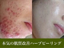 オーエン 小倉店(o-eN)の雰囲気（何をしても改善しなかった方必見！お肌の土台から生まれ変わる◎）