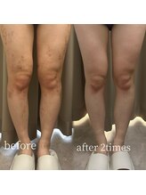 ラミパス(LAMIPAS)/韓国クリニック提携　ケア