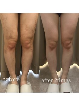 ラミパス(LAMIPAS)/韓国クリニック提携　ケア