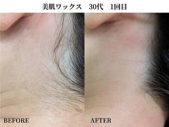 サンビ(SANBI)/産毛ケアはSANBIにお任せ！