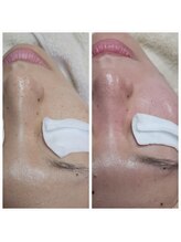 サロン ザ プマロ(SalonThePumalo)/赤み/たるみ/毛穴開き/黒ずみ