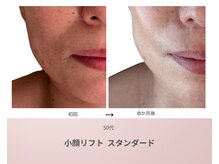 リアン(Lien)/50代ビフォーアフター