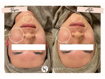 ルプレ(Lupure)/ハーブピーリング2回目