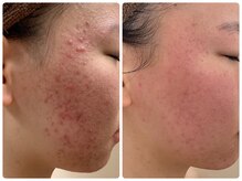 エステティックレイビス 名古屋店(RAYVIS)/どんな肌悩みもお任せください♪